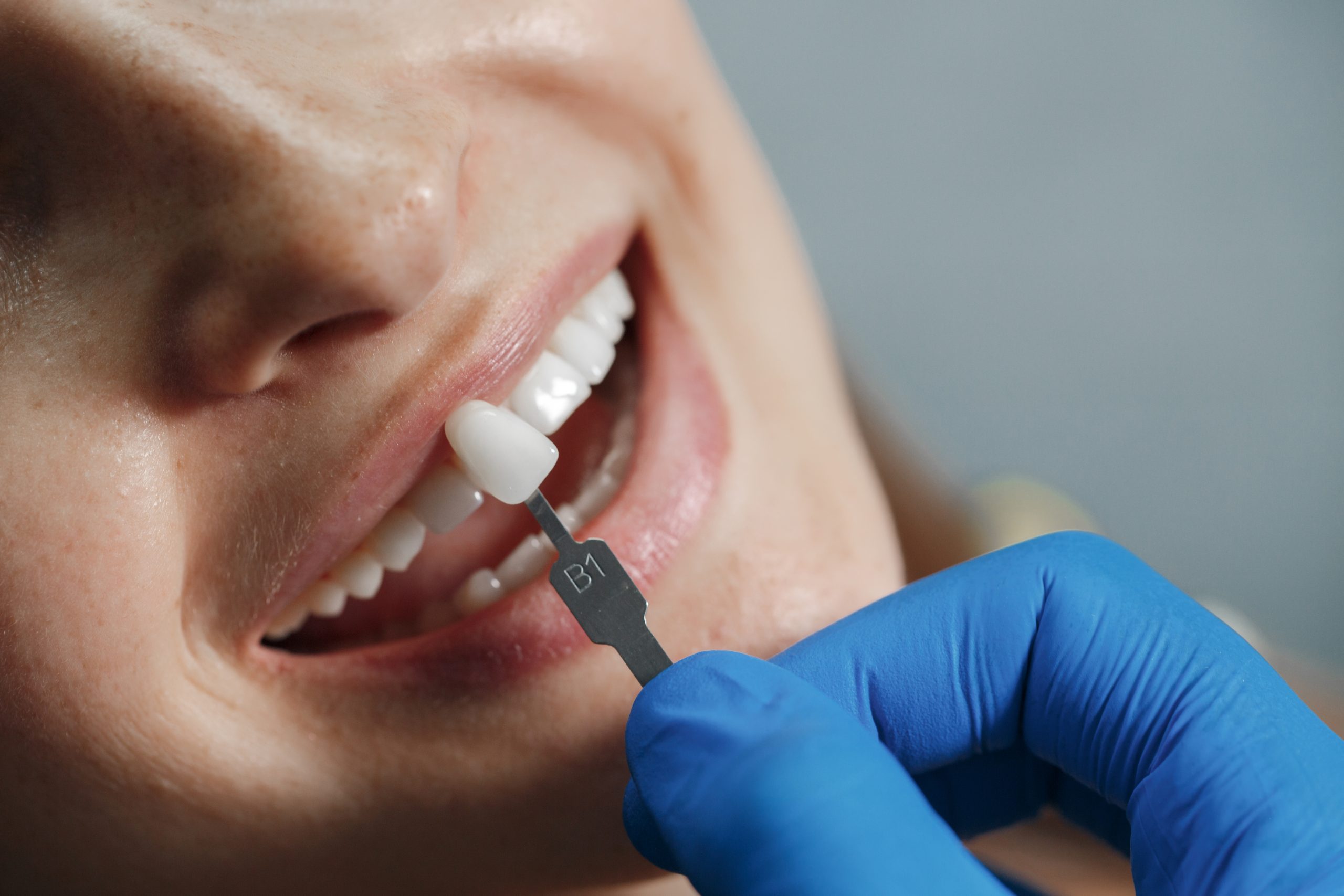 No-prep Dental Veneers