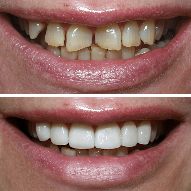 Porcelain Veneers Before and After stained teeth