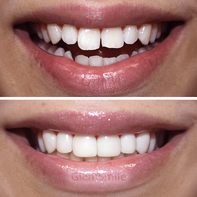 Porcelain Veneers Before and After uneven teeth
