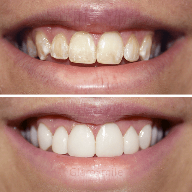 Porcelain Veneers Before and After Discolouration and mottling