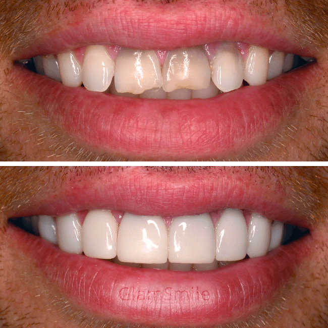 Porcelain Veneers Before and After discoloured teeth