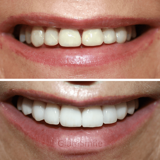 Porcelain Veneers Before and After Replacing old composite bonding