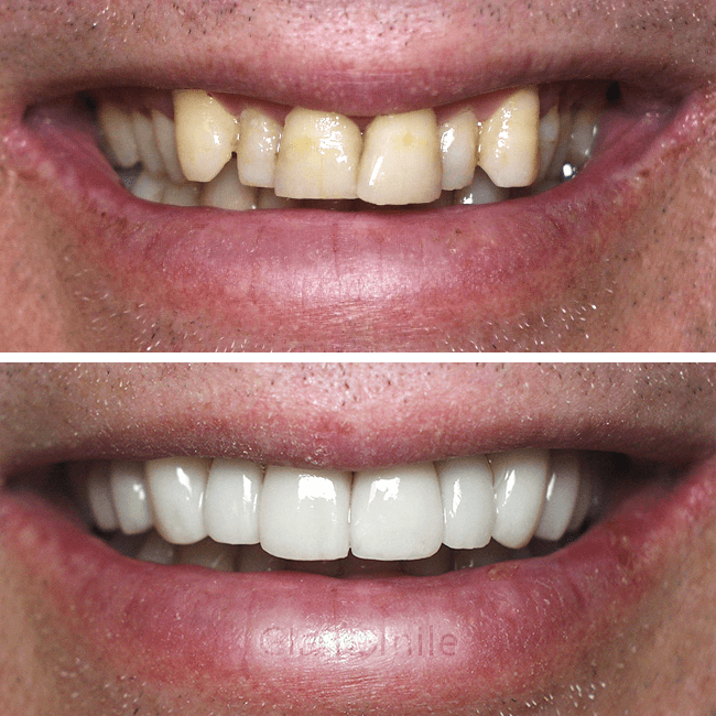 Porcelain Veneers Before and After uneven teeth