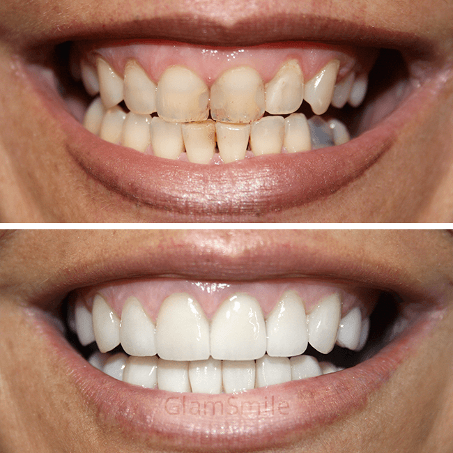 Porcelain Veneers Before and After discouloured teeth