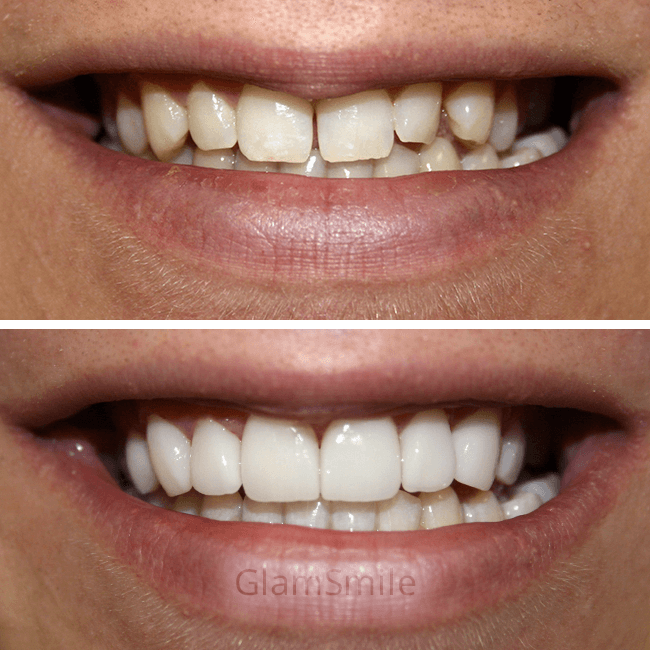 Porcelain Veneers Before and After Crooked and uneven smile