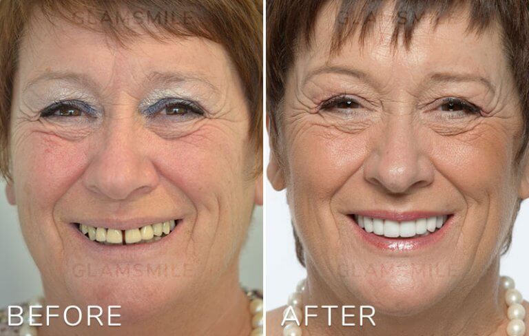 Affordable Cosmetic Dentistry | Hollywood Smile Makeover \u0026 Veneers